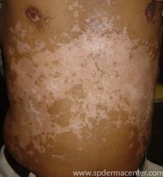 Vitiligo-Before